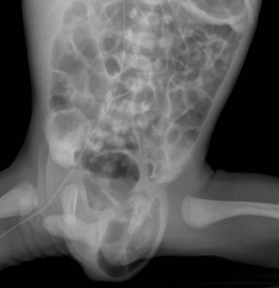 Inguinal Hernia Radiograph Radiology Case Radiopaedia - vrogue.co