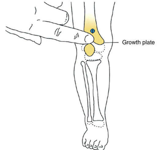 distal femur distal femur