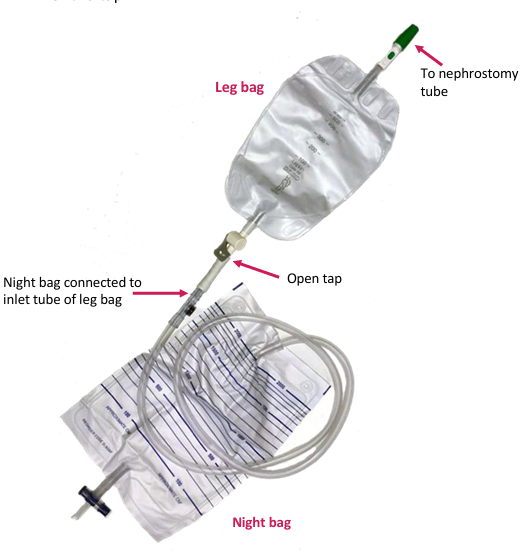 Nephrostomy Tube Care At Home