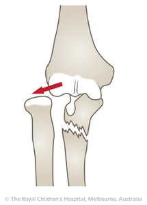 Fracture - monteggia fracture dislocations