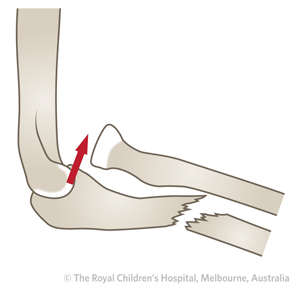 Fracture - monteggia fracture dislocations