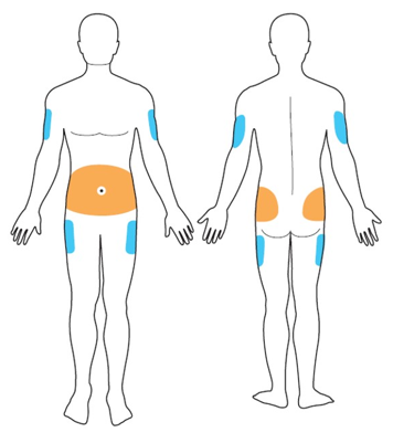 Subcutaneous Catheter Device I-Port Advance Subcutaneous Catheter Device I-Port Advance