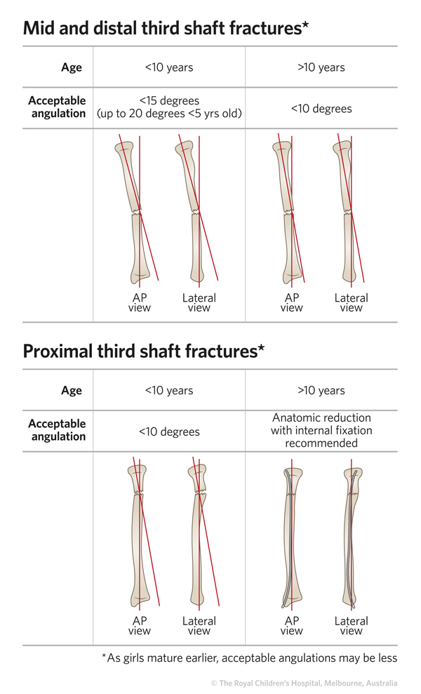 Radius And Ulna Shaft Fracture