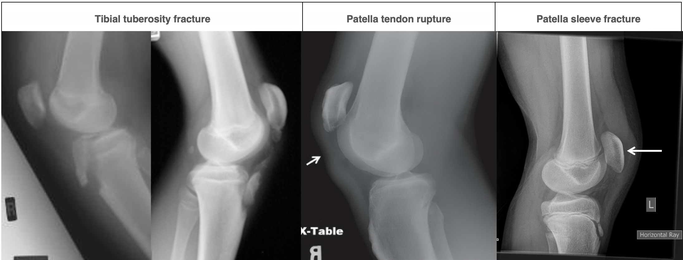 Xrays After An Acute Knee Injury Kneeguru