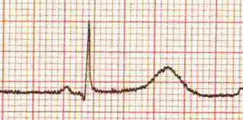 Long Qt Syndrome