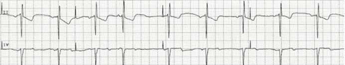 Pacemakers (temporary) for a child