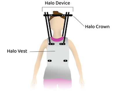 Halo vest management