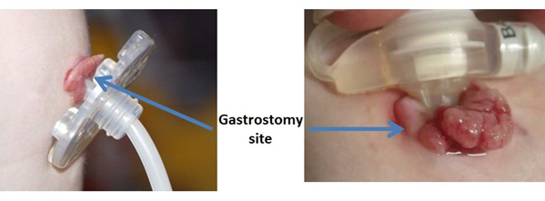 Gastrostomy Transgastric Jejunal Jejunal Tube Care