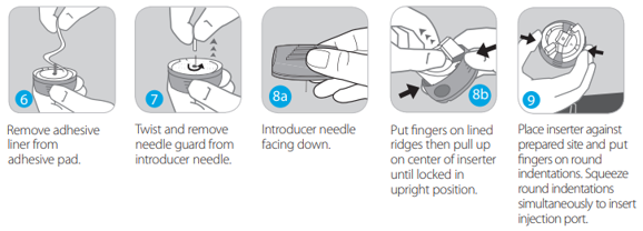 how to inject glutathione using butterfly syringe What is Butterfly Cannulation?