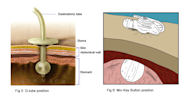 G Tube Placement Laparoscopic Feeding Gastrostomy