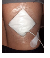 Nephrostomy tube management