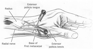 Local anaesthetic for minor procedures