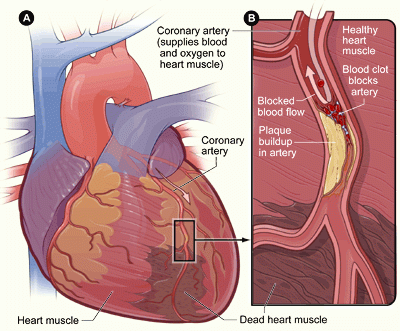 Heart attack-NIH