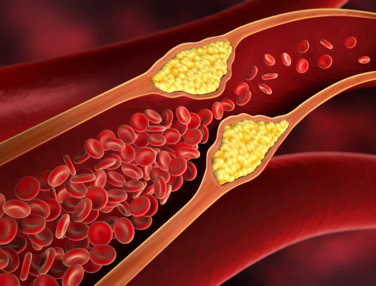Illustration of blood cells flowing through artery with plaque