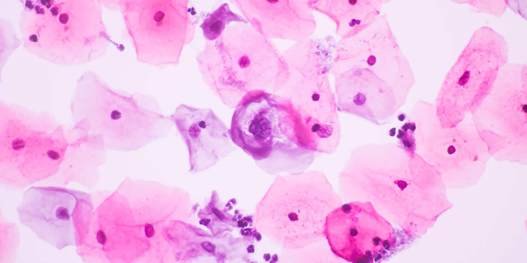 Microscopic image of cells with HPV infection that can result in HPV complications