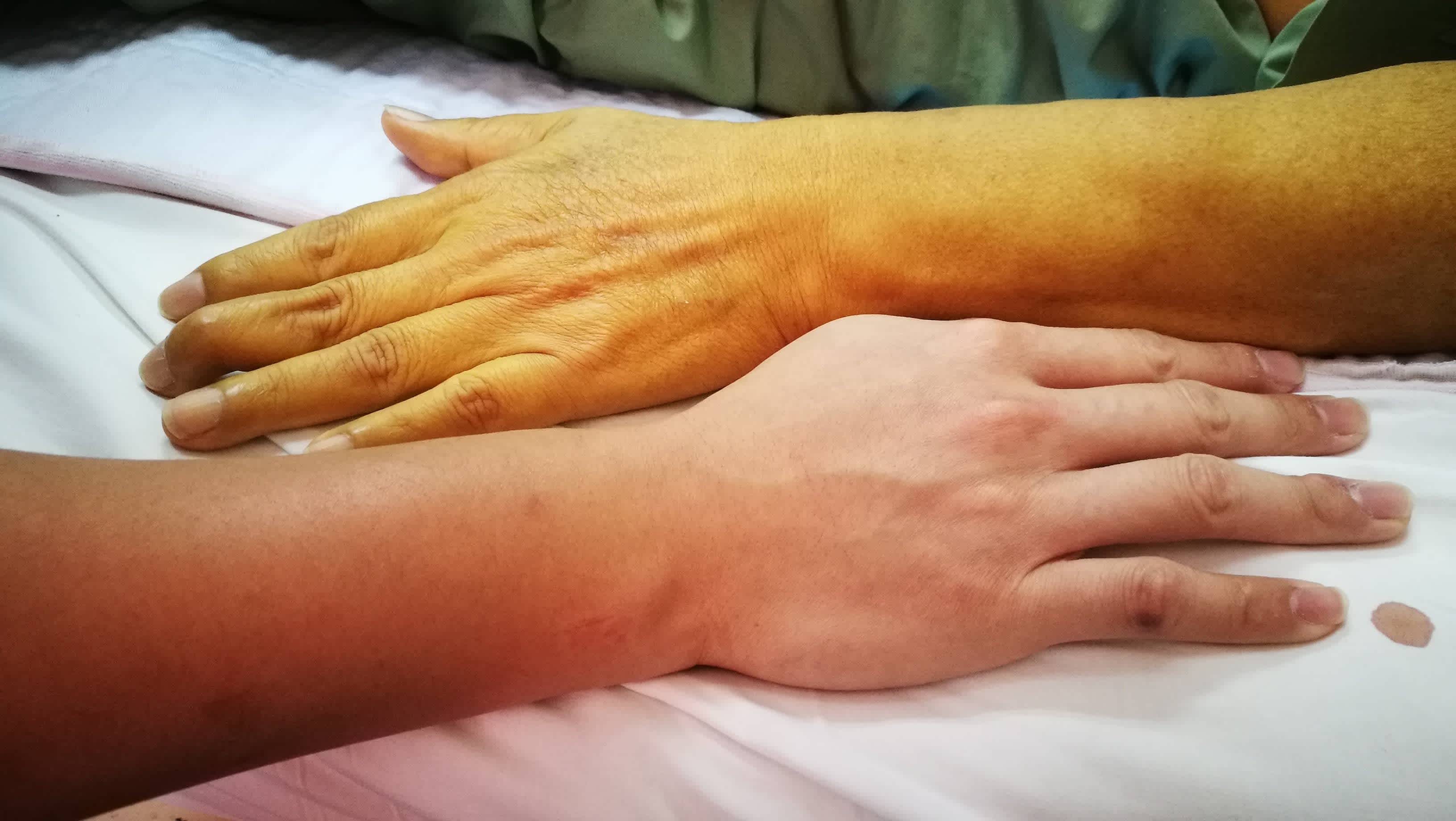 Image of yellow-looking arm with jaundice next to healthy arm