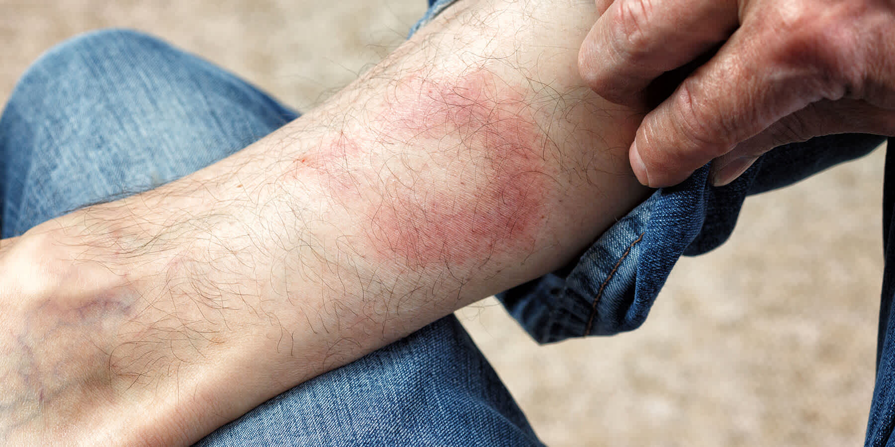 How accurate are Lyme disease tests? Blog Everlywell Home Health