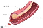 arteryplaque (1)
