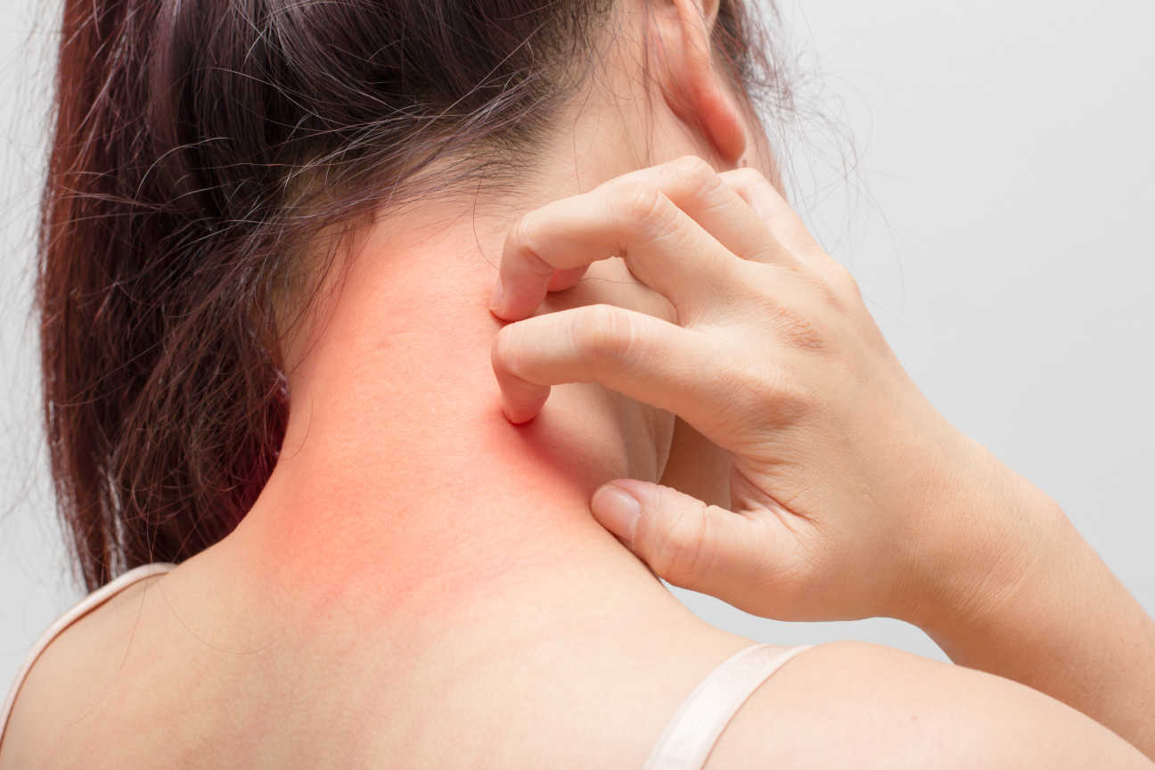 Eczema on neck