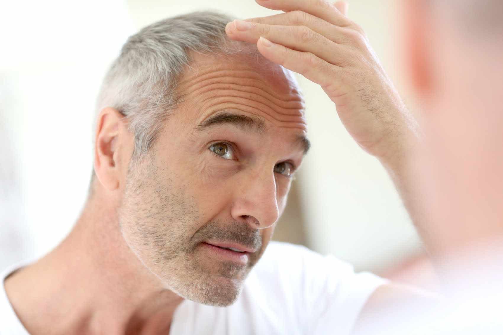 Man looking in mirror to check hair loss from syphilis infection