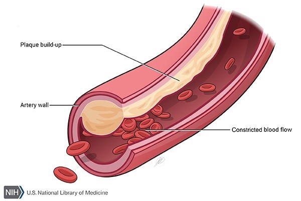 arteryplaque (2)