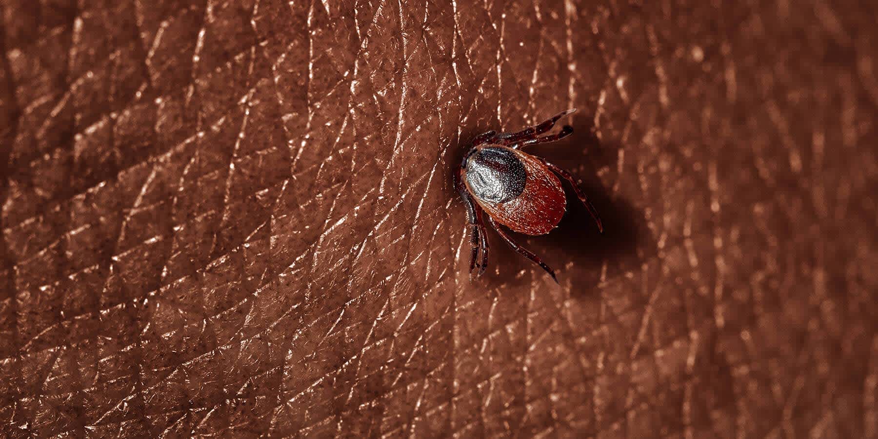 Tick with tick-borne disease burrowing into person's skin