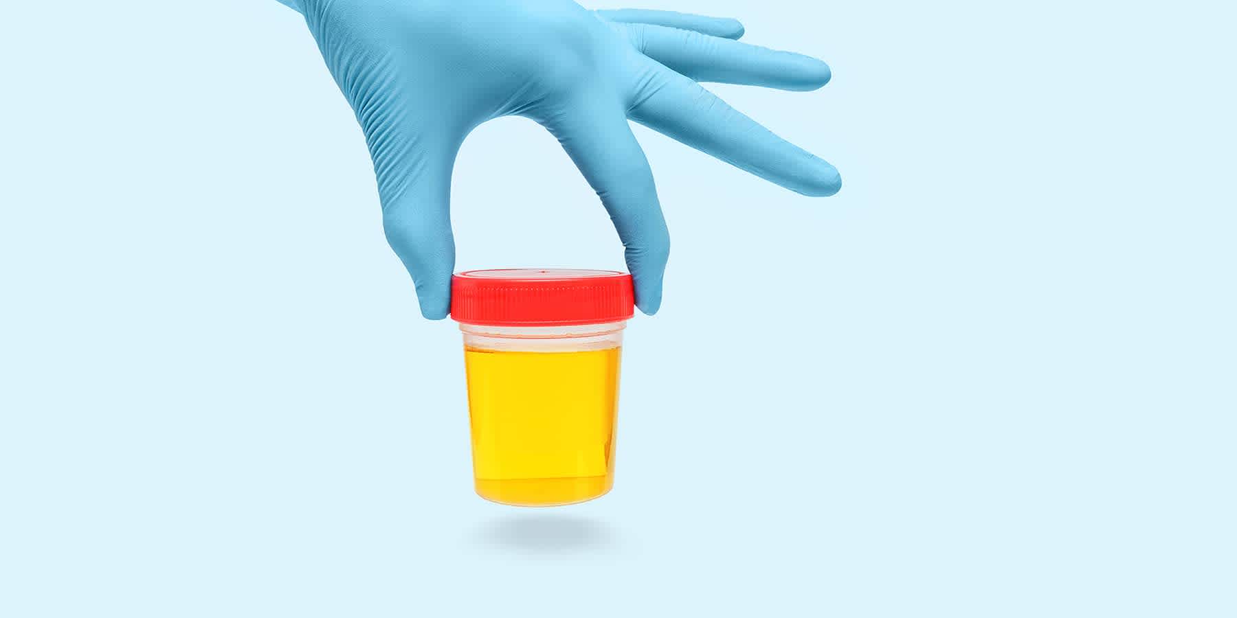 Healthcare provider with gloved hand holding urine sample to check for bladder infection vs. UTI