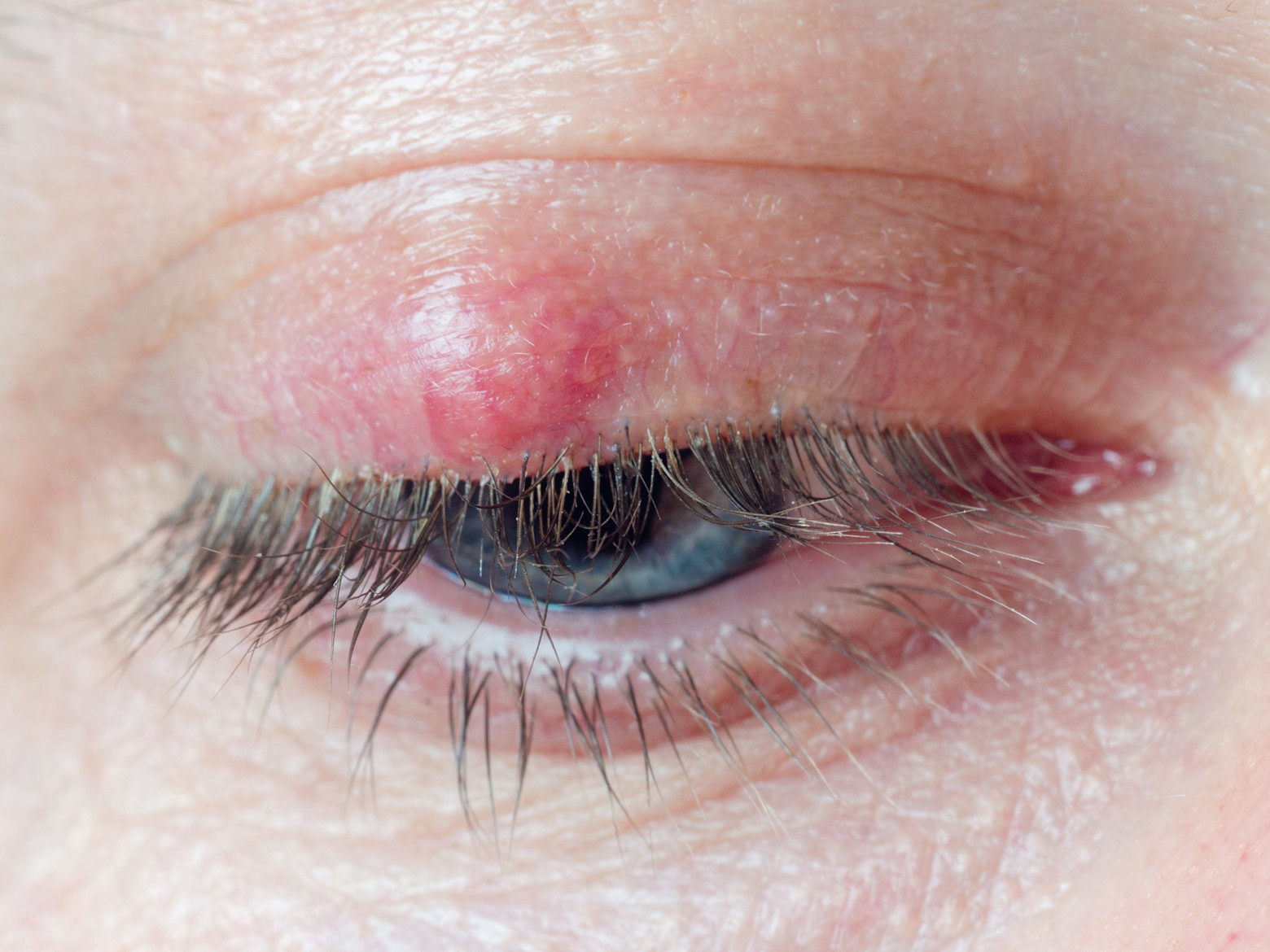 Stye | Symptoms, Treatments and Causes | Specsavers New Zealand