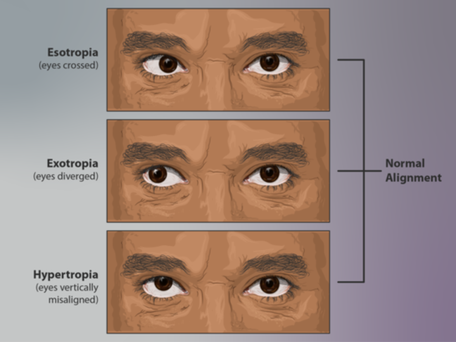 Strabismus and squints – spotting signs and getting help | Specsavers ...