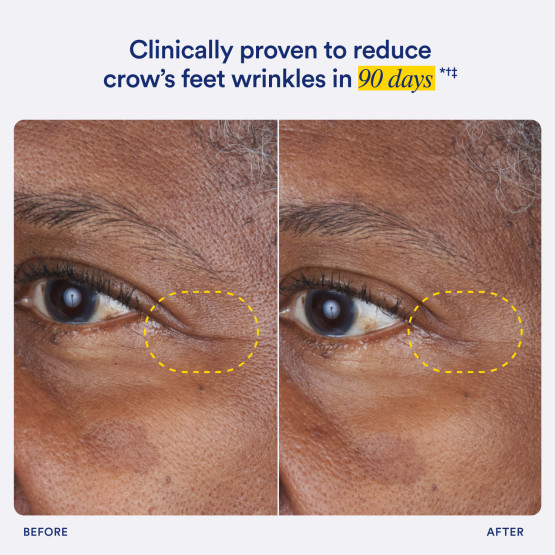 A side by side comparison showing how HyaCera is clinically proven to reduce crow's feet wrinkles in 90 days.