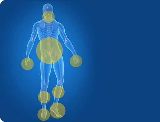Representación visual de áreas del cuerpo afectadas por la neuropatía