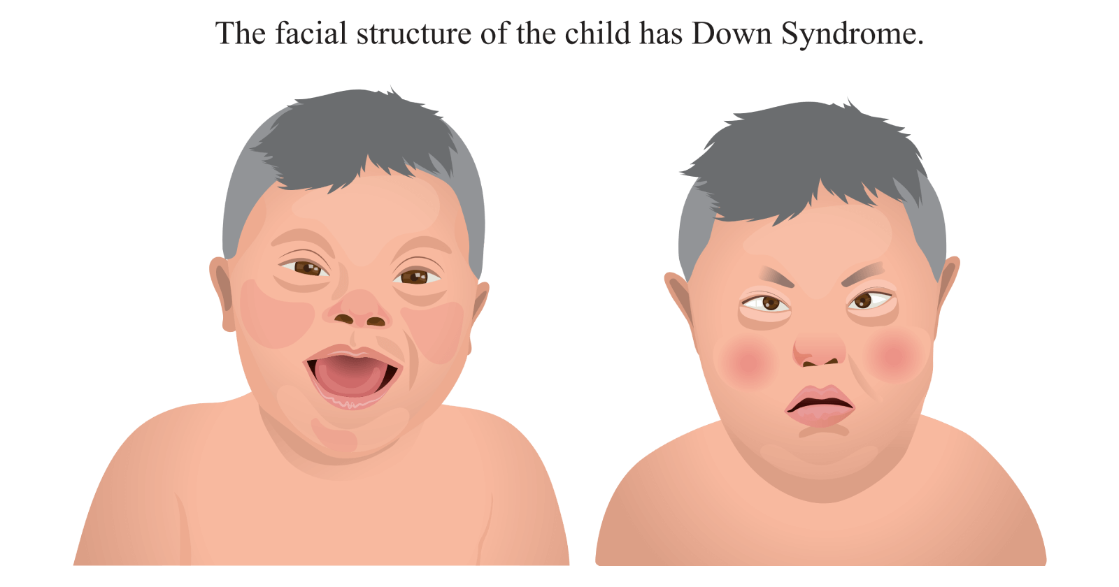 Understanding Down Syndrome: Causes, symptoms, diagnosis, & treatment