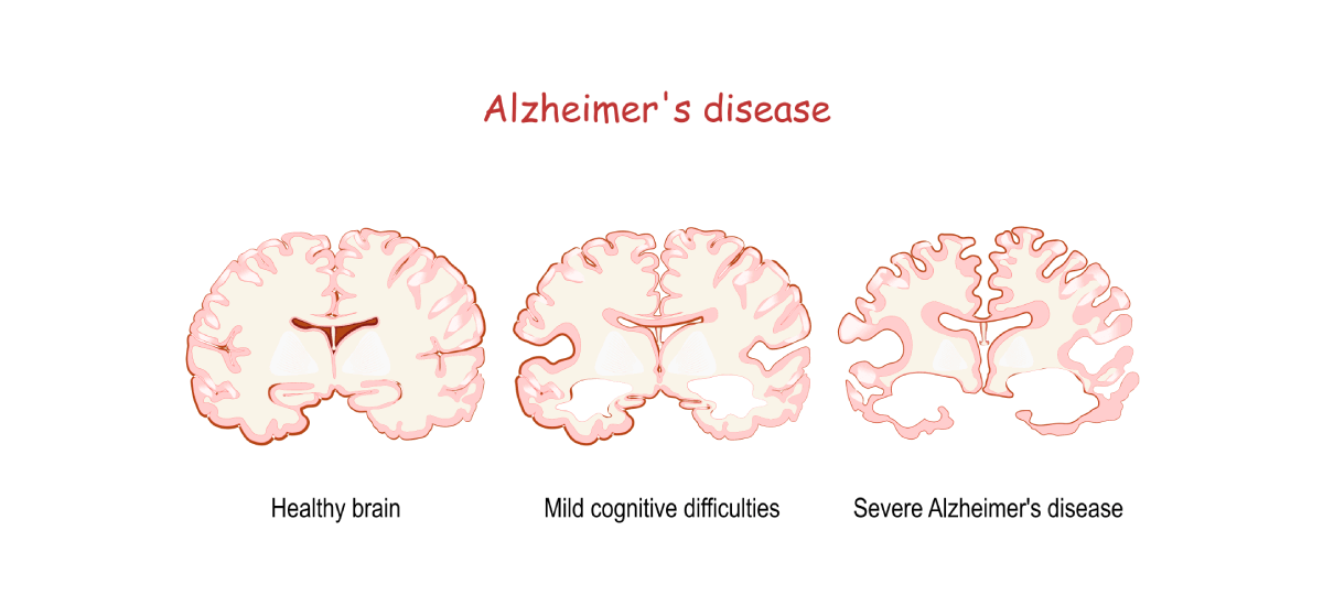 Alzheimer's Diseases: Symptoms, Causes, Types And Treatments