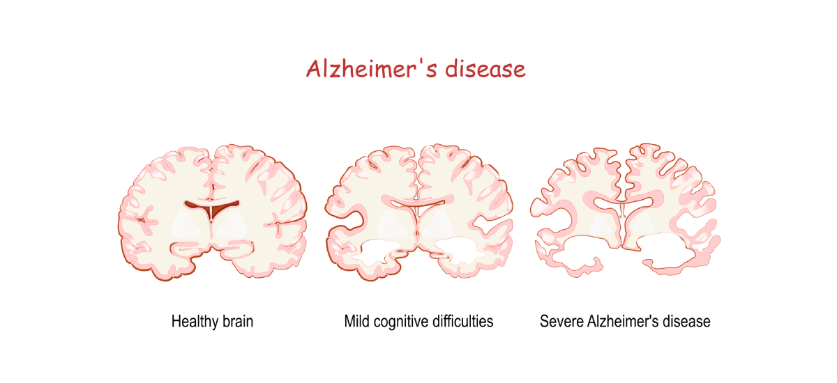 Everything You Need to Know About Alzheimer's Diseases