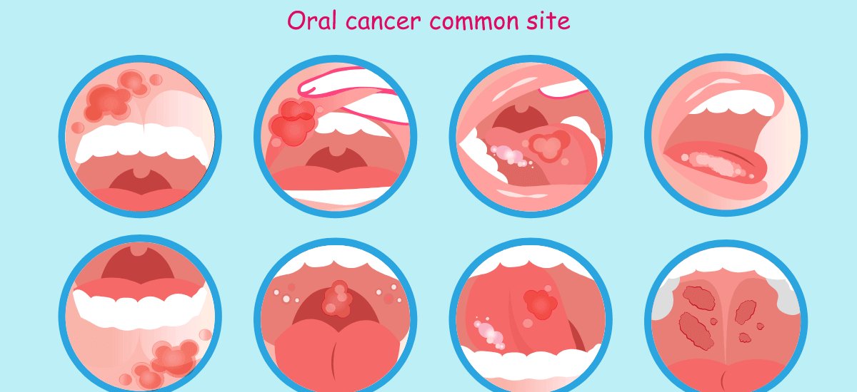 Oral Cancer: Symptoms, causes, types, and treatment 