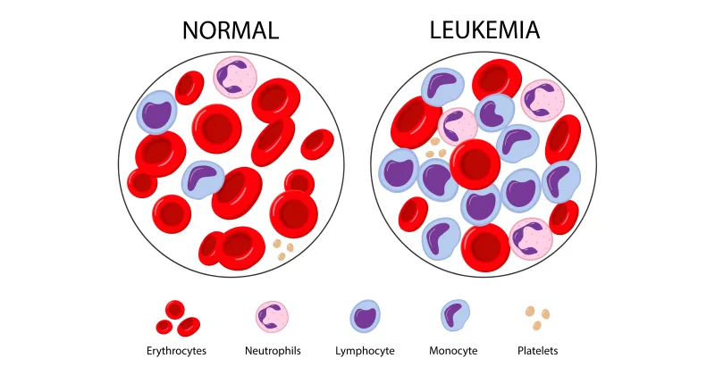 Leukaemia Cancer