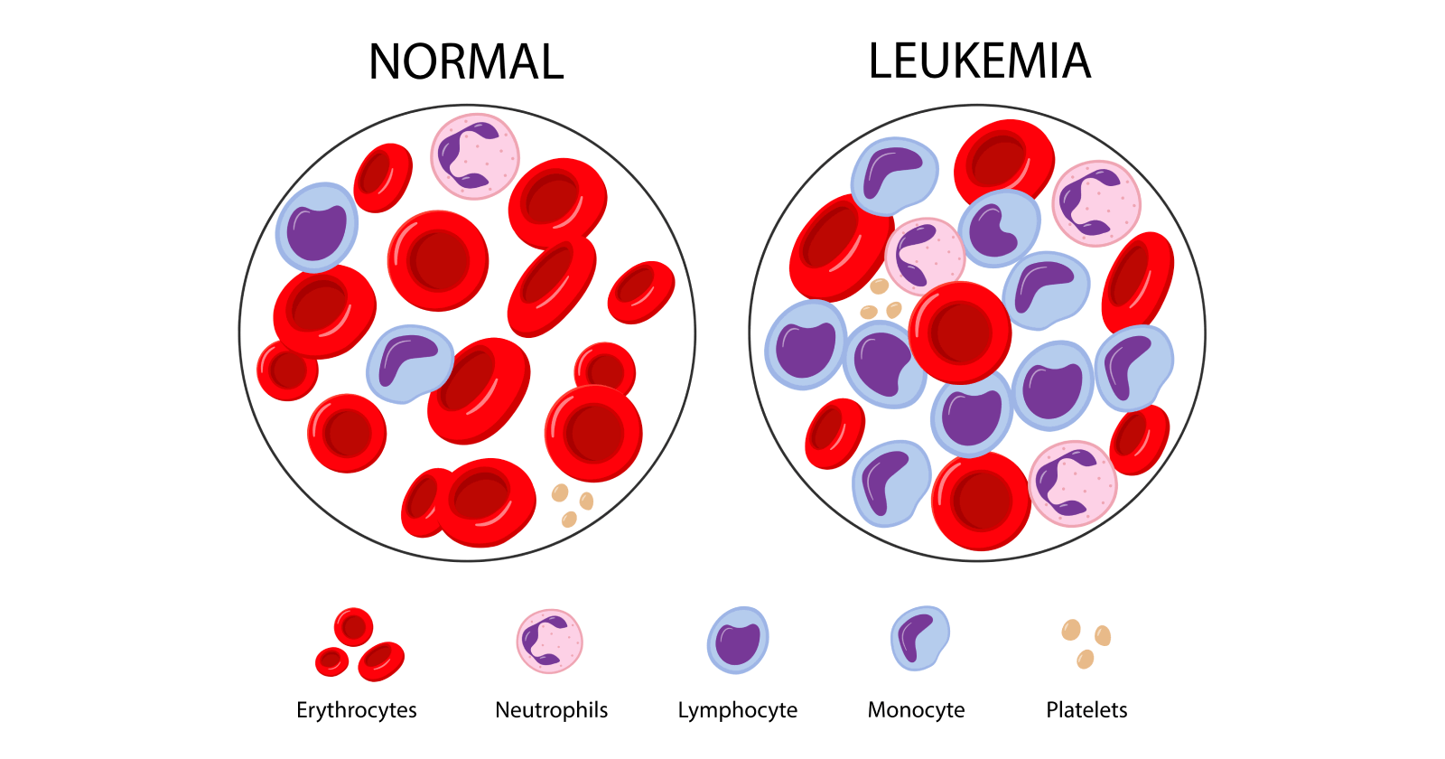 leukaemia-cancer-symptoms-causes-prevention-and-treatments