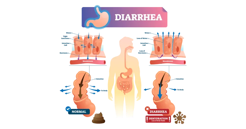 Diarrhoea