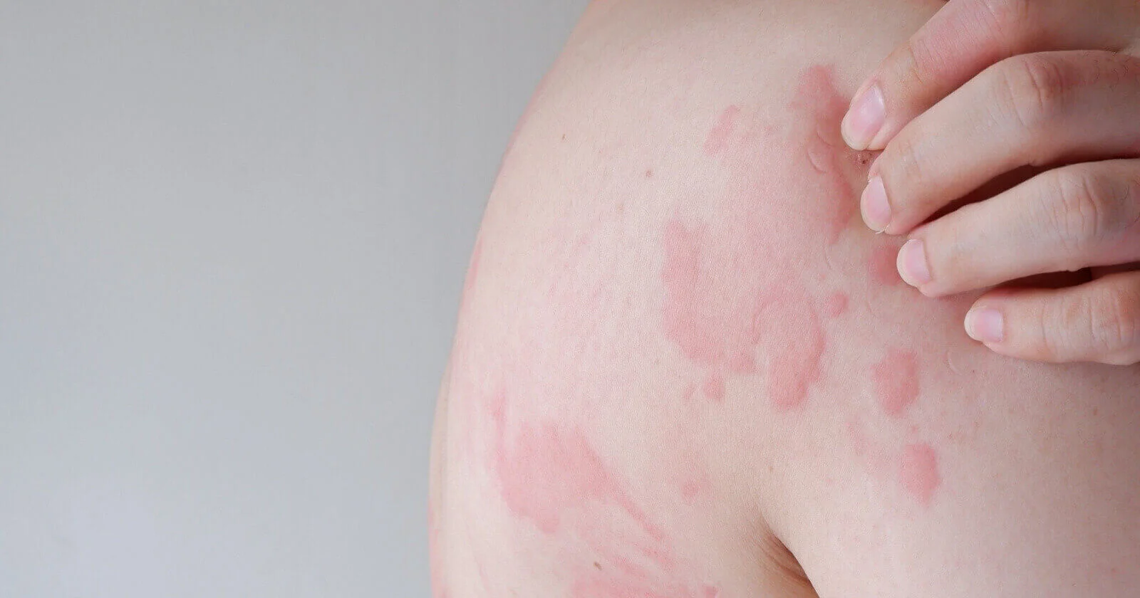 Get Natural Relief from Your Hives With Proven Urticaria Treatments