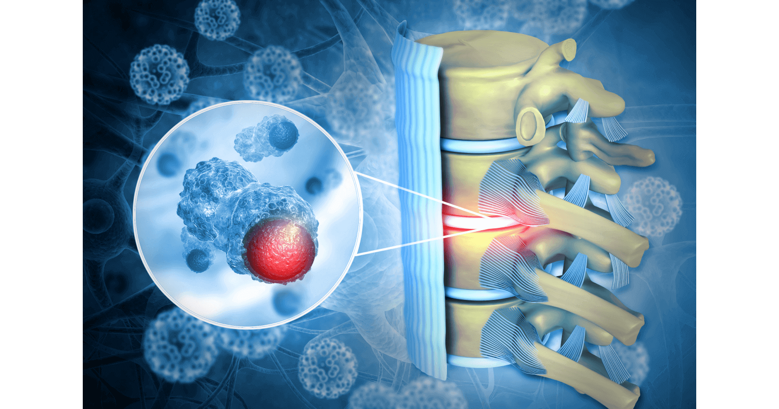 Understanding Spinal Cord Tumours: Types, symptoms, diagnosis and treatment
