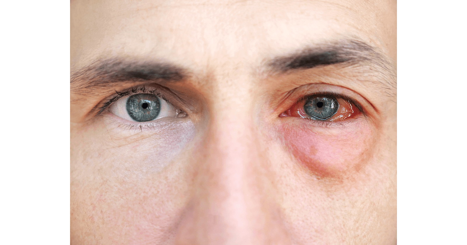 Eye Allergies 
