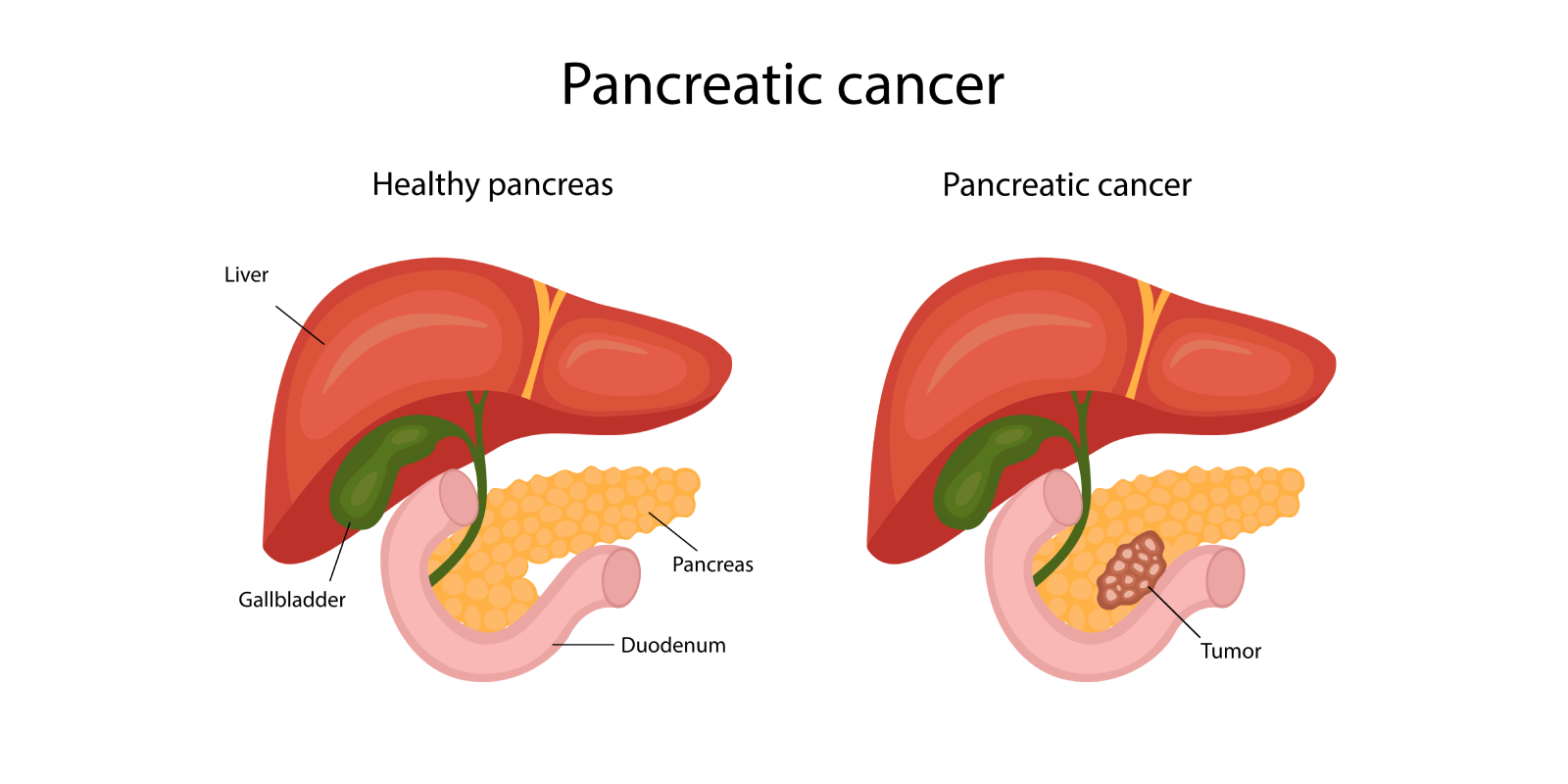 Pancreatic cancer: What Is It, Symptoms, Causes & Treatment
