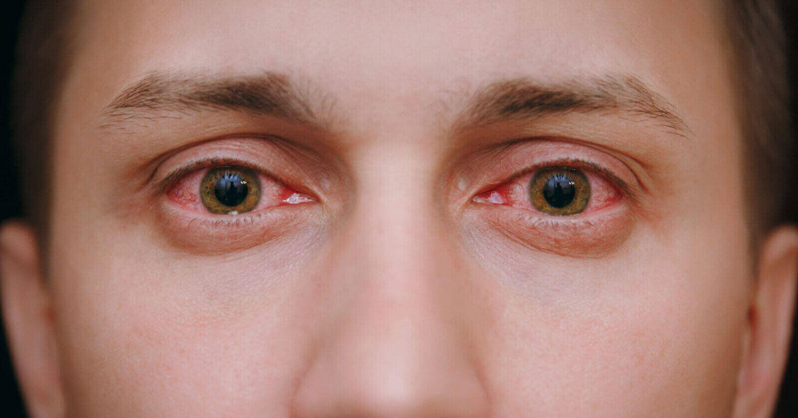 Overview of Red Eye: Definition, symptoms, causes and treatment