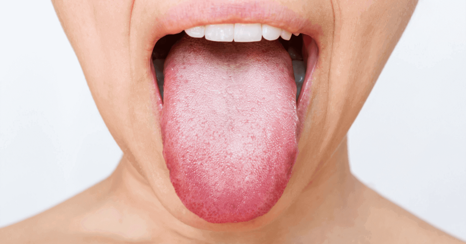 White Tongue: Causes, Treatments & Prevention