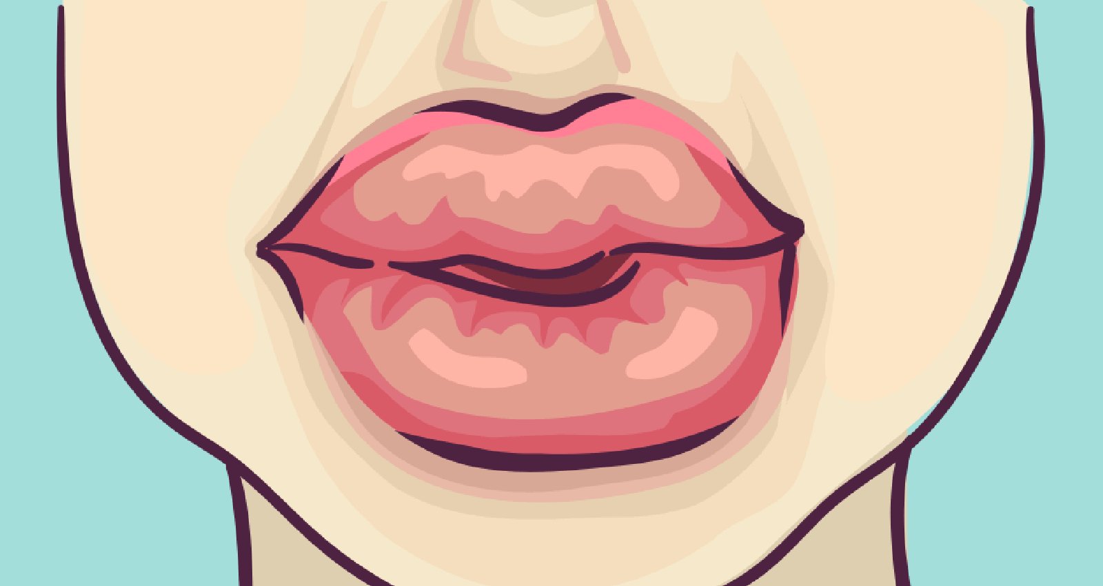 Swollen Lips (Allergy) Symptoms, Causes, Treatments & Home Remedies
