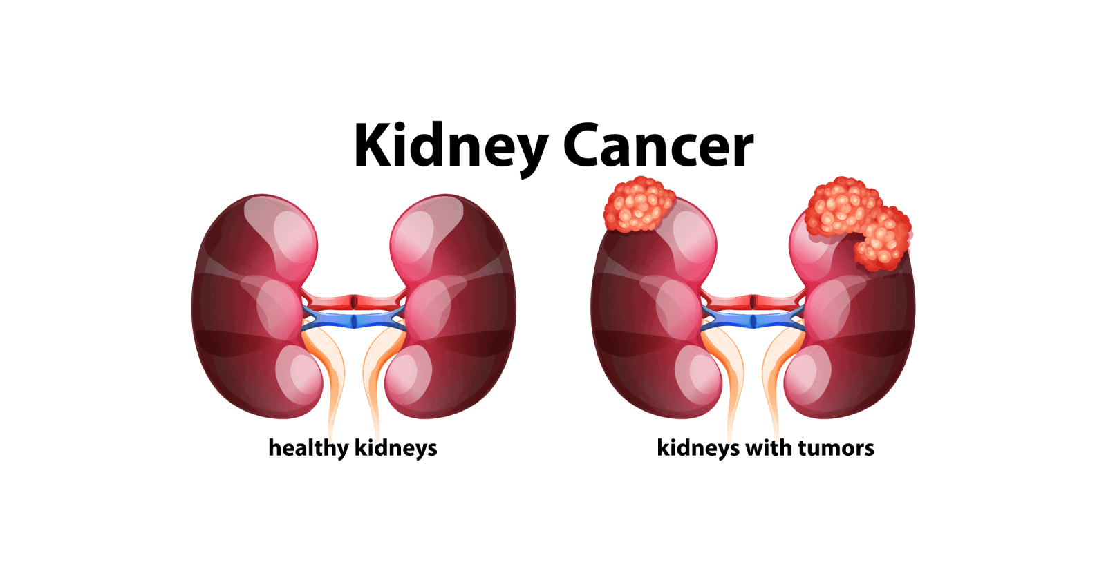 kidney-cancer-symptoms-causes-types-stages-treatment