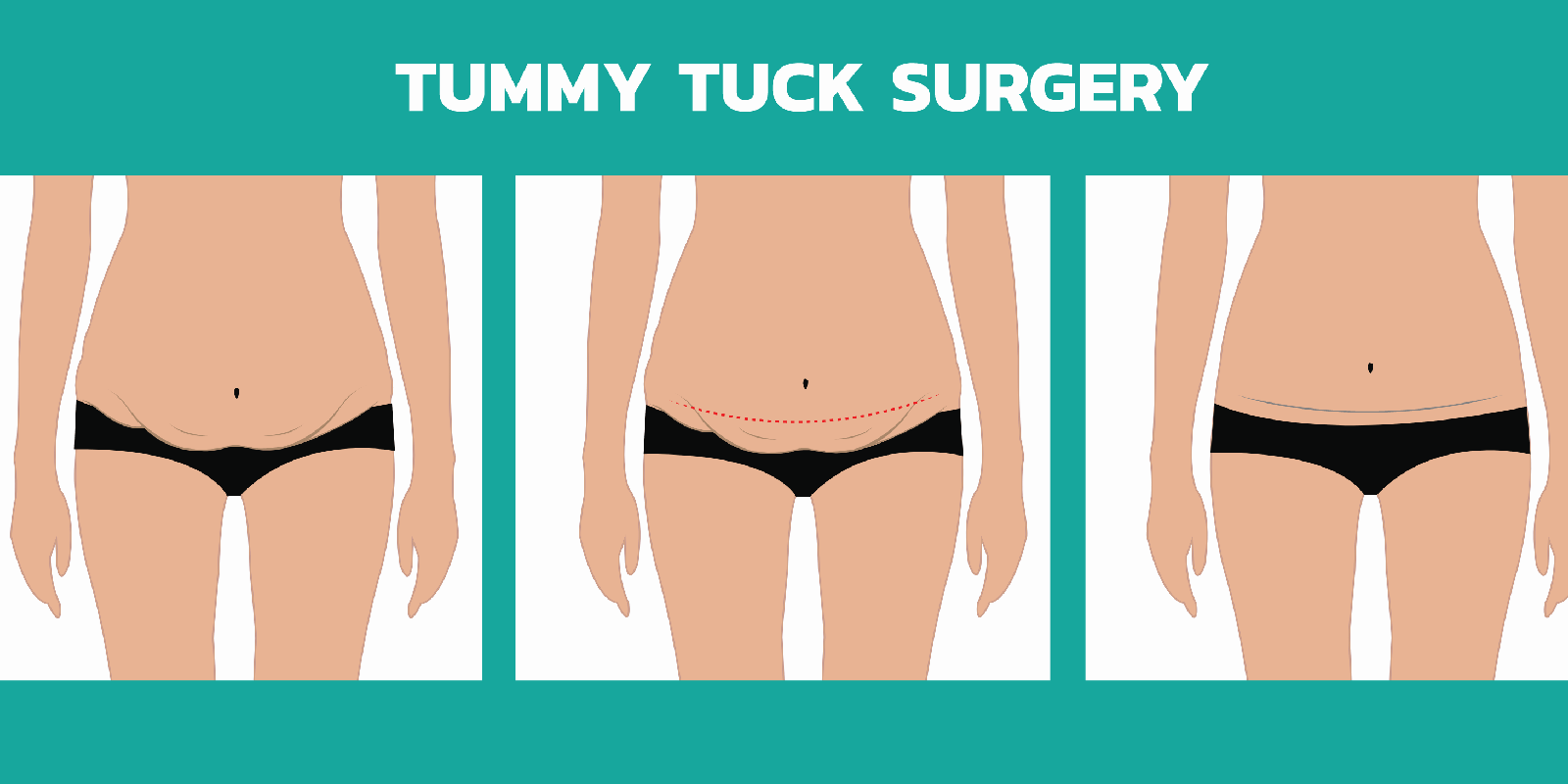 Tummy Tuck Surgery : Overview, Steps & & Potential complications