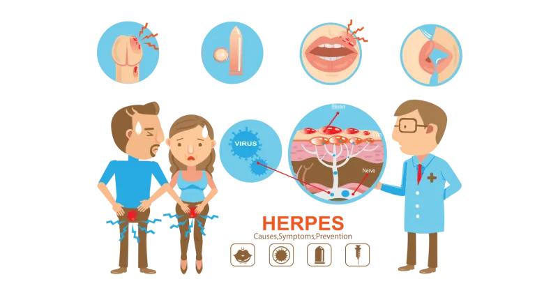 Herpes
