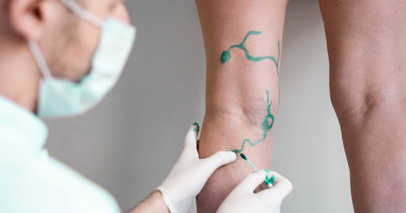 What Is Vascular Surgery? Common Diseases, Diagnosis & Prevention