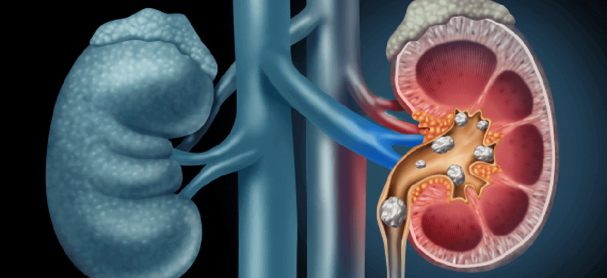 Kidney Stones: Symptoms, Causes, Types, Diagnosis & Treatment